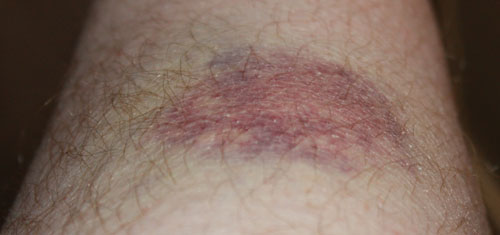Bruising